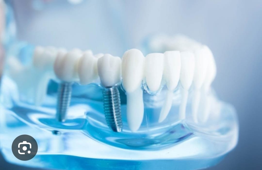 Conventional Dental
                            Implants