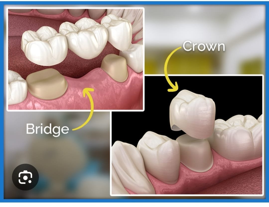 Crowns and Bridges