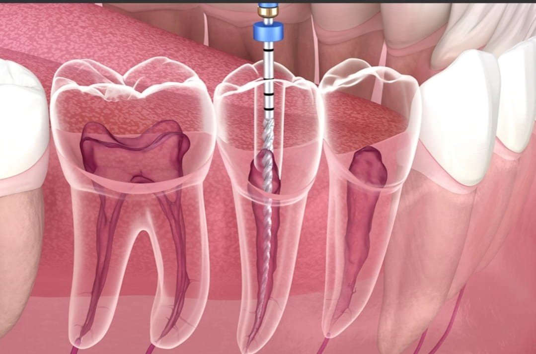 Root Canal Treatment